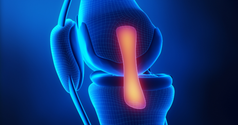 שחזור רצועה צולבת ברך