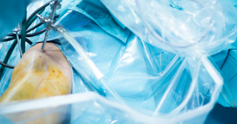 ארטרוסקופיה ברך